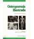 Osteoporosis ilustrada