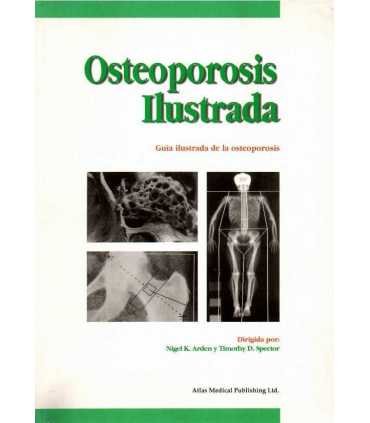 Osteoporosis ilustrada