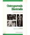 Osteoporosis ilustrada